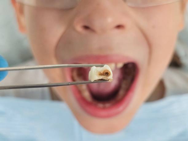 Best Emergency Dentist for Lost Fillings or Crowns in Cuthbert, GA